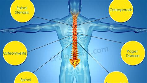 Osteoarthritis Back Pain Treatment Treat Choices