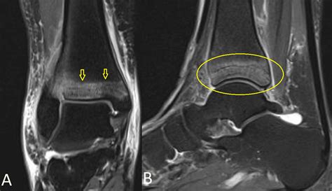 Cureus Atraumatic Isolated Stress Fracture Of The Distal Tibial