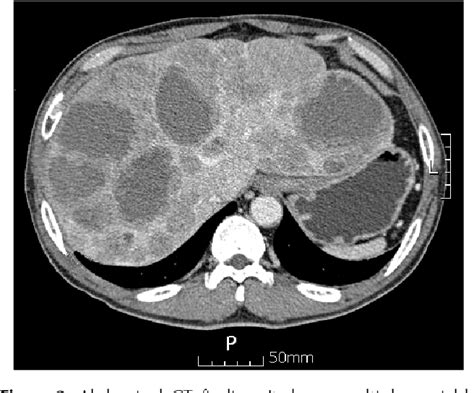 Figure 1 From A Case Of A Small Rectal Carcinoid Tumor With Multiple