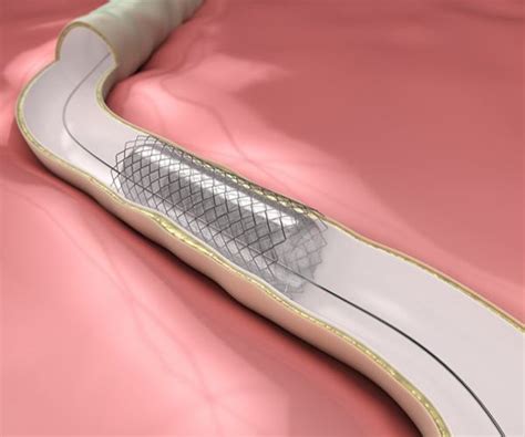 Dissolving Heart Stent Showing Promise Study Ratemds Health News