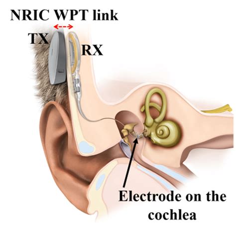 Med El Cochlear Implant Nric Wpt Link Adopted With Permission From Med