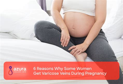 Why Some Women Get Varicose Veins During Pregnancy