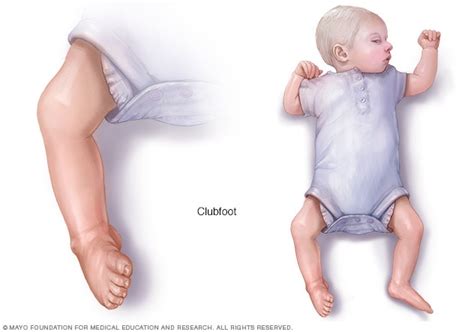 Clubfoot splint vaanguradhuku munnadi idha oru time paarunga #kural_inidhu #clubfoot. Clubfoot - Symptoms and causes - Mayo Clinic