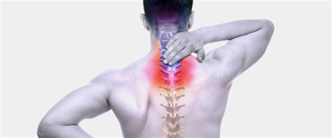 14 Causes Of Pinched Nerve In Neckcervical Radiculopathy