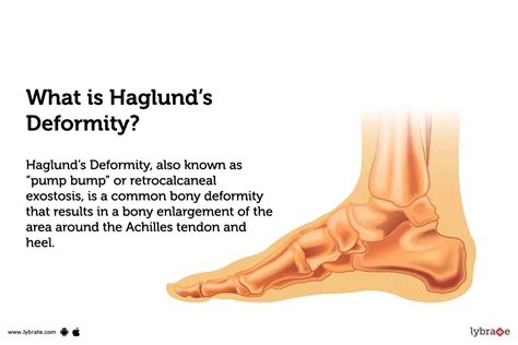 Top Heel Haglund Deformity Best Esthdonghoadian