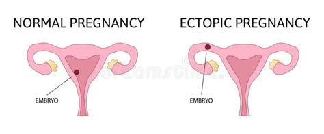 Ectopic And Normal Pregnancy The Fertilized Egg Uterus Womb Stock