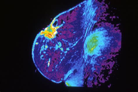 If you have a large breast cancer, your doctor may order a ct scan to assess. News — Oakland MRI