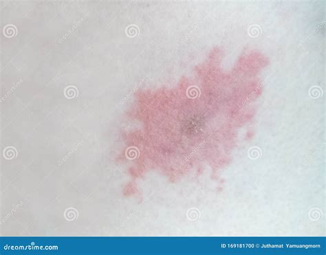 Chest Skin Rash As Drug Side Effect After Surgery Royalty Free Stock