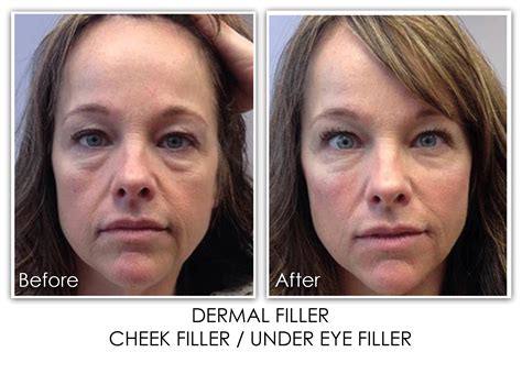23 Dermal Filler Under Eye Filler Skin Rejuvenation Clinic Skin