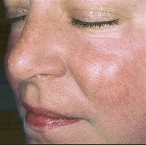 Acne And Rosacea Treatments At Mirabel Clinic Swindon