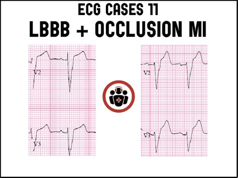 Lbbb And Occlusion Mi Ecg Cases Emergency Medicine Cases