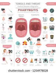 Tonsils Throat Diseases Peritonsillar Abscess Symptoms Stock Vector Royalty Free