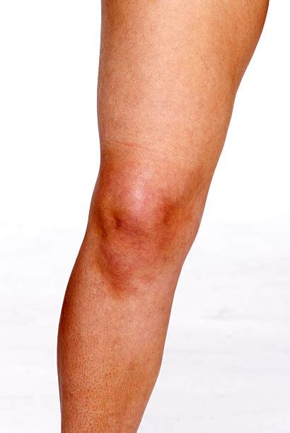 Knee Bone Pictures Images And Stock Photos Istock