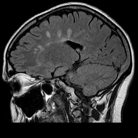In the past few years, magnetic resonance imaging (mri) has become increasingly relevant in the diagnosis of multiple sclerosis (ms). Multiple sclerosis | Image | Radiopaedia.org