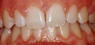 spazio tra  denti davantiincisivi centrali