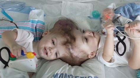 Conjoined Twins See Each Other For First Time After Surgery