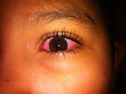 Konjunktivitis kann eine erkältung und andere systemische virusinfektionen (einschließlich masern, sowie windpocken, röteln und mumps) begleiten. Madras eyes Archives - Utsav Eye Clinic