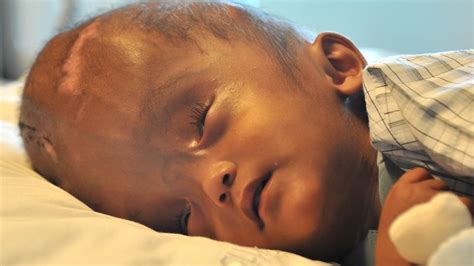Swollen Head Baby Leaves Hospital After Successful Surgery