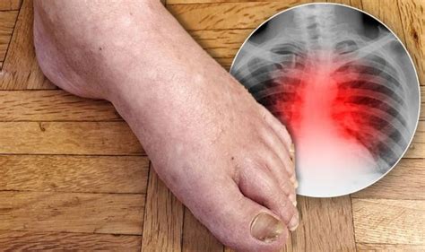 Heart Attack Symptoms Signs Of Heart Disease Include Swollen Feet Or