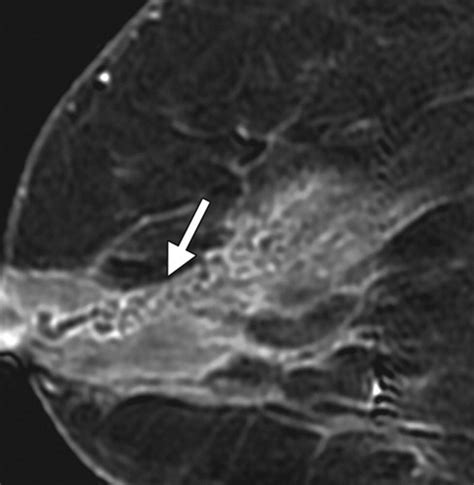 Ductal Carcinoma In Situ Of The Breast Mr Imaging Findings With