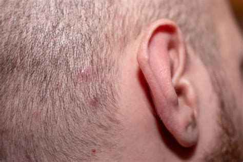 How To Treat Ingrown Hair On Scalp Easy Care Tips Bald Beards