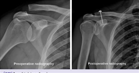 Figure 1 From Surgical Treatment Of Type Iii Acromioclavicular