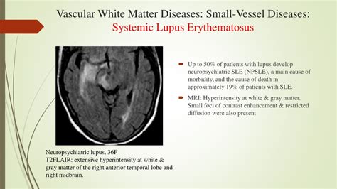 Ppt White Matter Diseases Powerpoint Presentation Free Download Id8763007