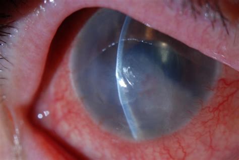 Pseudophakic Bullous Keratopathy Eyewiki