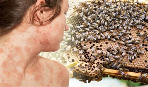 Eczema Treatment Putting Honey On Your Skin Could Slash Symptoms And