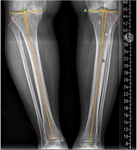 Figure 2 From Tibial Reference Point In Total Knee Arthroplasty In