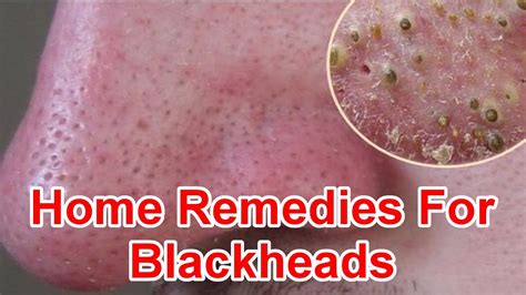 Home Remedies For Blackheads Removal Youtube