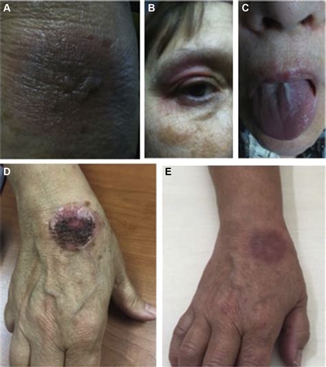 Bullous Fixed Drug Eruption Secondary To Chlorthalidone The Journal