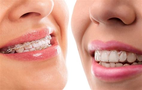 When we met our patients in real life, we listen to their past dental habits, previous dental work, and beliefs. Invisalign Clear Braces