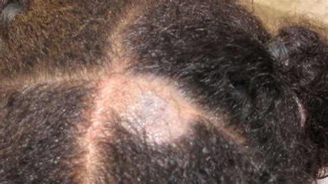 Skin Lesions On Head