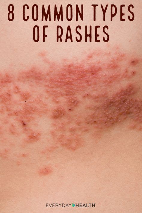 8 Common Types Of Rashes Skin Beauty And Hair Types Of Rashes