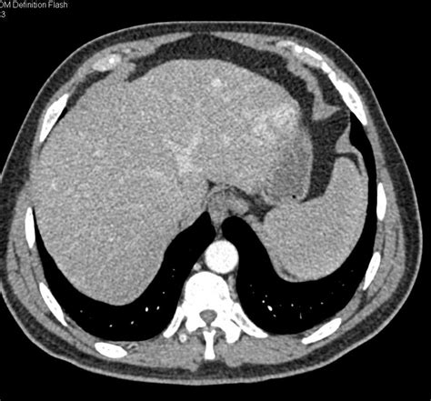 Carcinoid Tumor With Liver Metastases Liver Case Studies Ctisus Ct