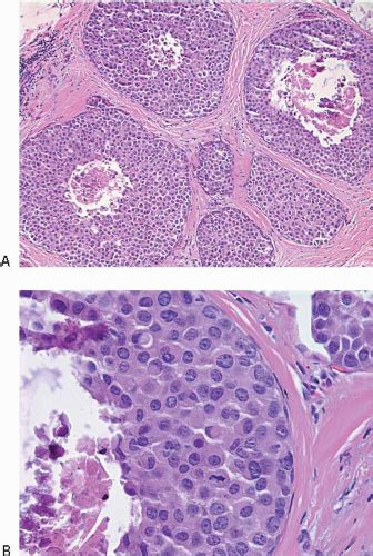 Lobular Carcinoma In Situ And Atypical Lobular Hyperplasia Oncohema Key