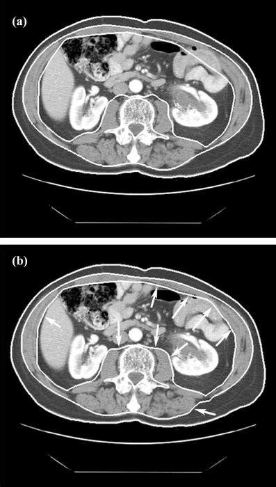 Axial Ct Image Of Abdomen At Third Lumbar Level The Bodycompslicer