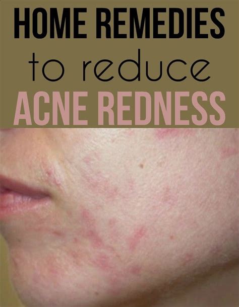 Home Remedies To Reduce Acne Redness Acne Redness Reduces Acne Skin