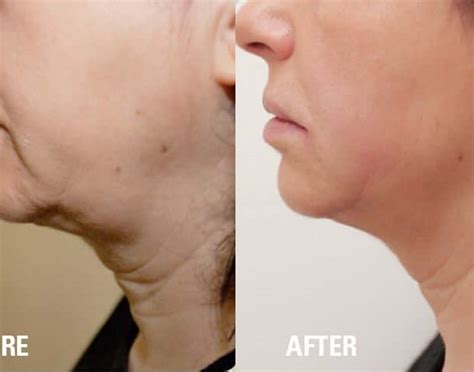 What Is A Non Surgical Necklift