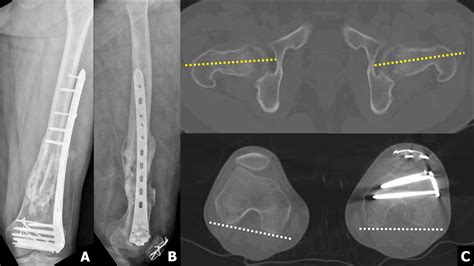 Malalignment After Minimally Invasive Plate Osteosynthesis In Distal