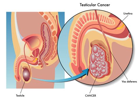 Identifying Testicular Cancer Symptoms Early Often Leads To A Cure
