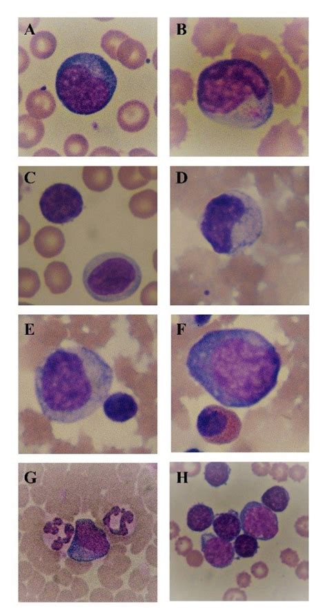 Myeloid Cells In Bone Marrow Smears A Prolymphocyte B Eosinophilic