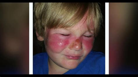 Boy Suffers Second Degree Burns Even After Applying 50 Spf Sunscreen