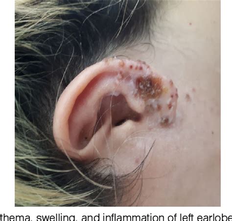 Figure 1 From Perichondritis Due To A Herpes Zoster Infection After An