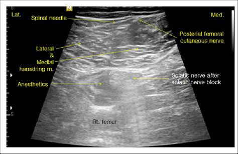 Posterior Femoral Cutaneous Nerve Pfcn Block Can Be Performed Using