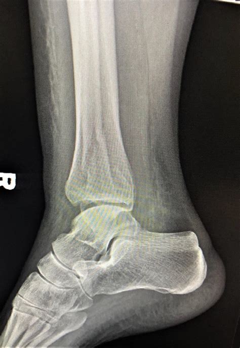 Ankle Fractures Trauma Orthobullets