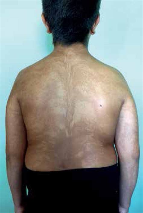 Scielo Brasil Do You Know This Syndrome Dyspigmentation Along The