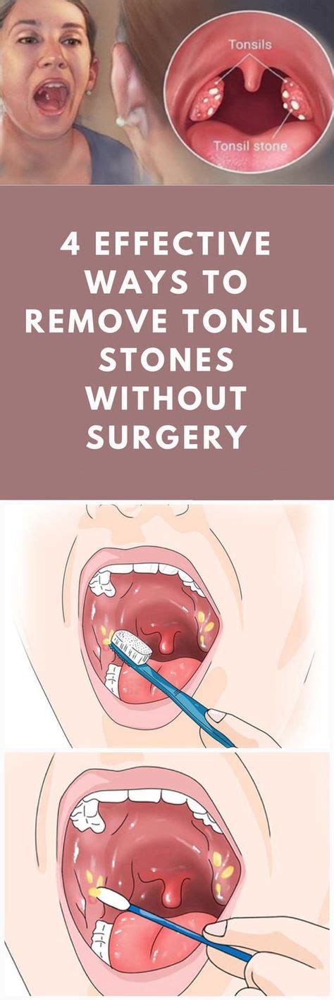 The Causes Of Tonsil Stones