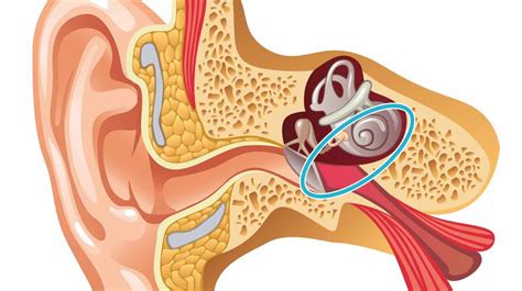 Although many times it leads to a permanent hearing loss in the affected ear. Types of Hearing Loss - SoundBright